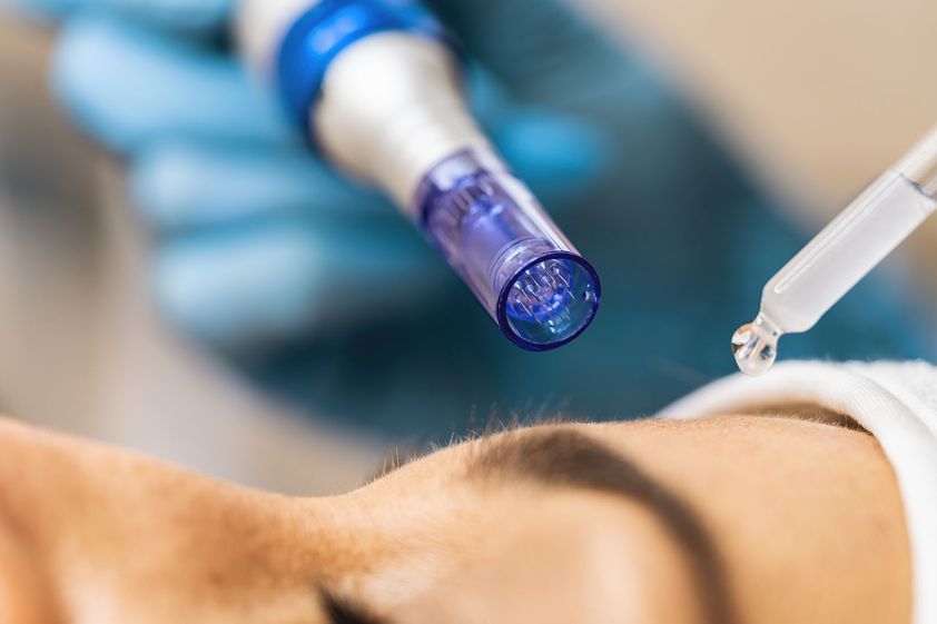 Microneedling resultate - 877303