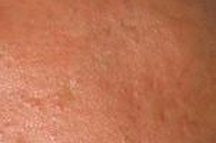 Aknebehandlung resultate - 780516