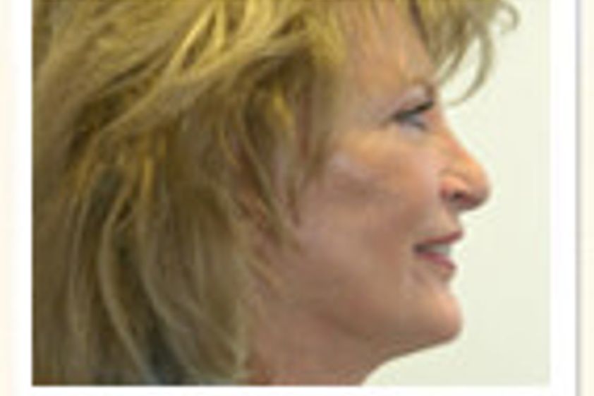 Facelift resultate - 779894