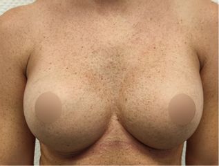 Brustvergrößerung - Dr. Pablo Hernandez