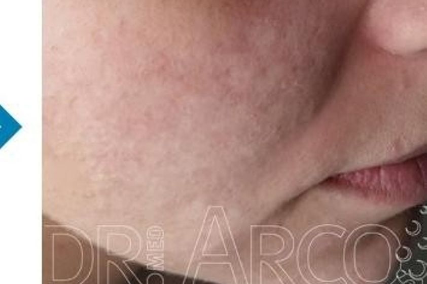 Peeling resultate - 782119