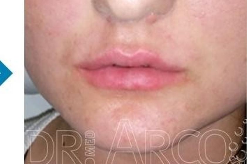 Lippen aufspritzen resultate - 782130
