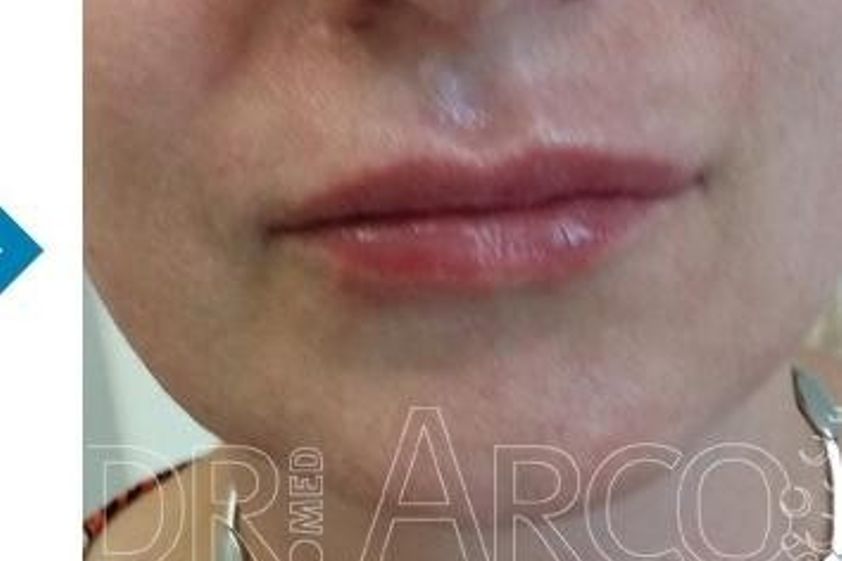 Lippen aufspritzen resultate - 782138