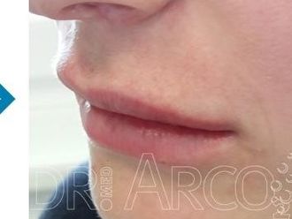 Lippen aufspritzen - 782140