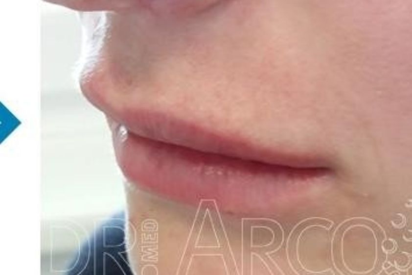 Lippen aufspritzen resultate - 782140