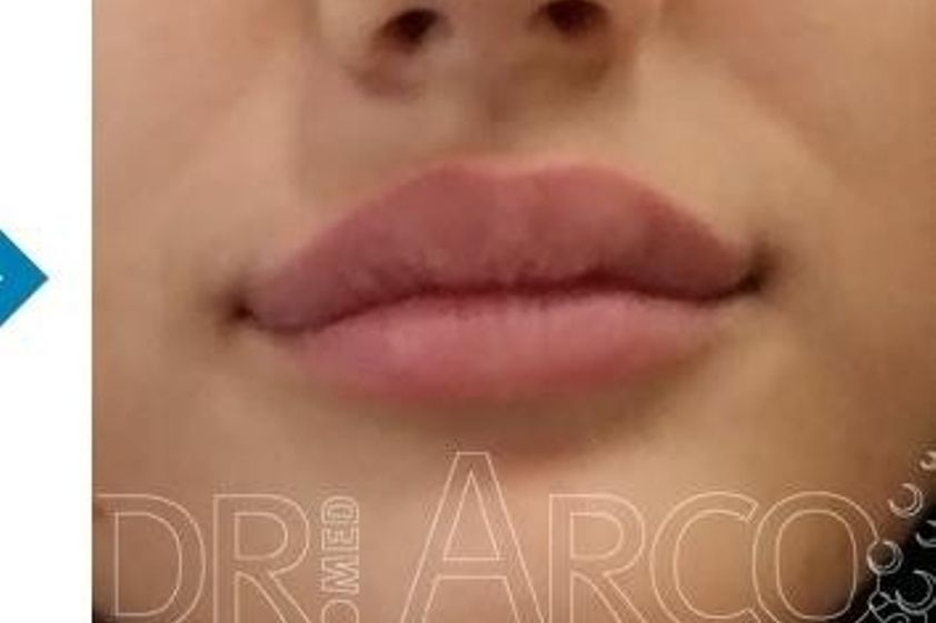 Lippenkorrektur resultate - 782143