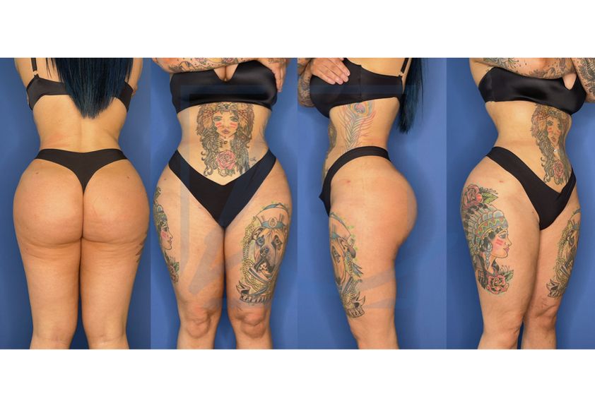 Brazilian-Butt-Lift resultate - 846855
