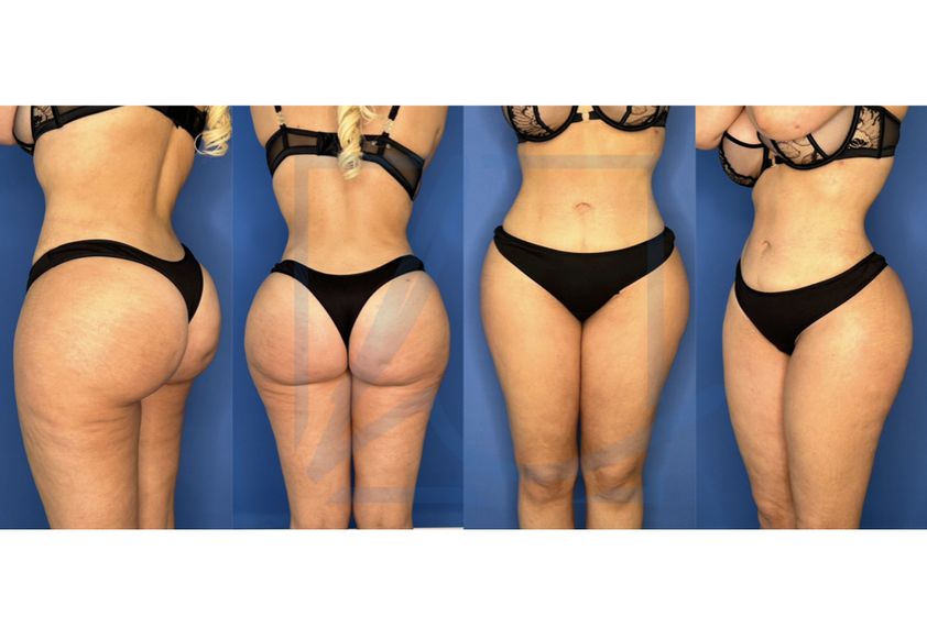 Brazilian-Butt-Lift resultate - 846859
