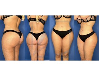 Brazilian-Butt-Lift - Dr. Alexander T. Hamers
