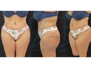 Bauchdeckenstraffung mit Liposuktion - Dr. Alexander T. Hamers