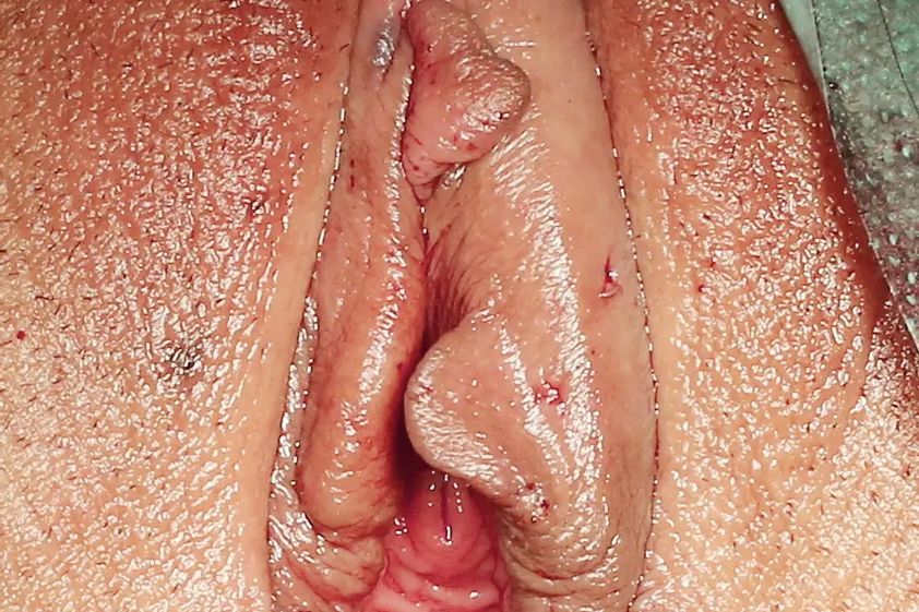 Vaginalstraffung resultate - 777020
