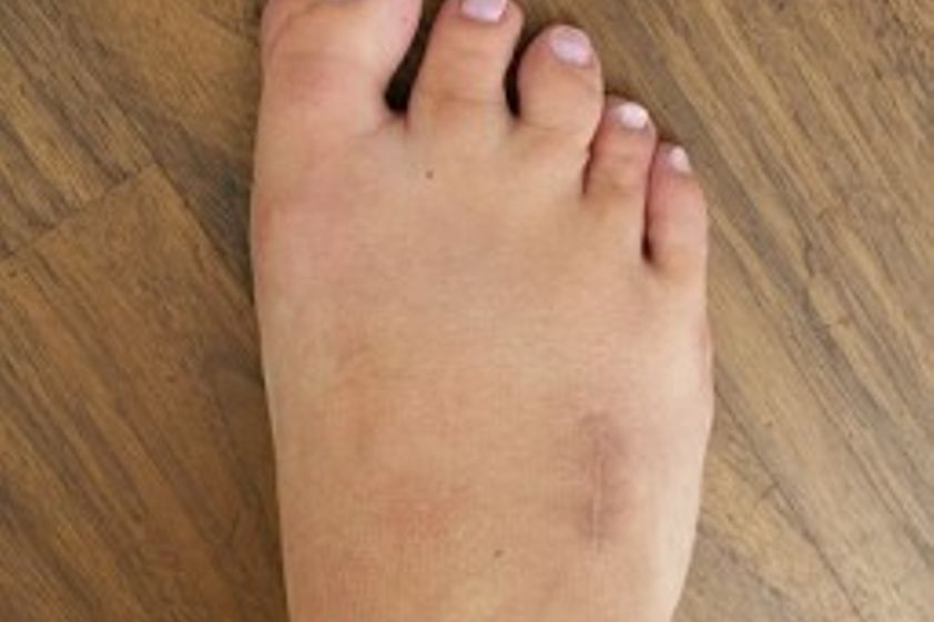 Fußchirurgie resultate - 779400