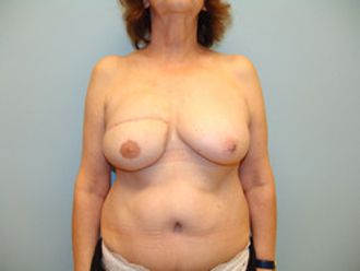 Brustrekonstruktion resultate - 779106