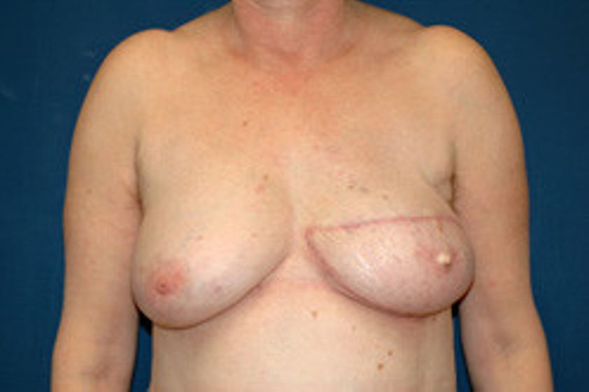 Brustrekonstruktion resultate - 779107