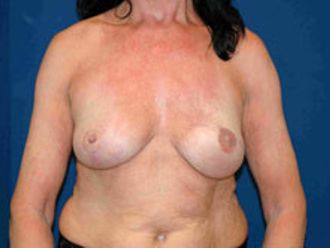 Brustrekonstruktion resultate - 779109