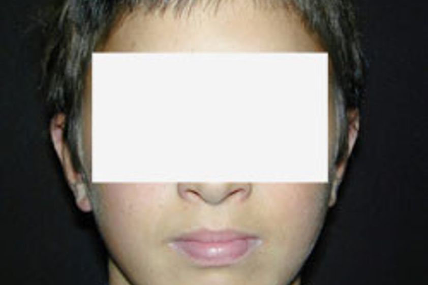 Otoplastik resultate - 779110