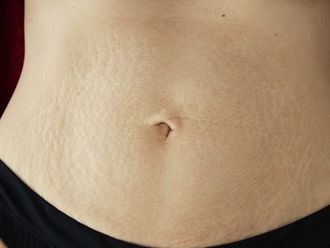 Microneedling resultate - 783588