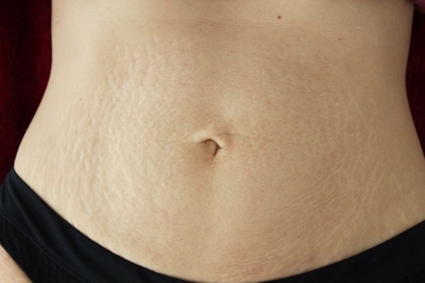 Microneedling resultate - 783588