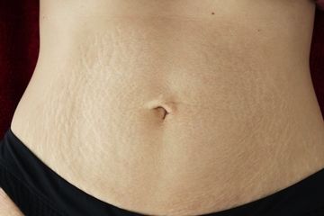 microneedling bauch vorher