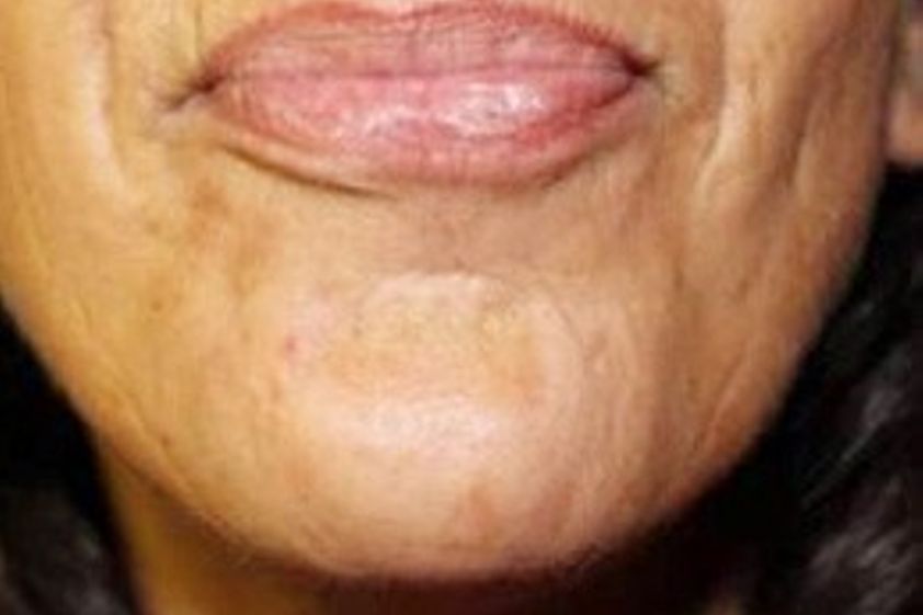 Botox resultate - 783606