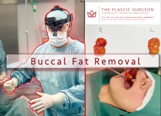 Buccal Fat removal Titelbild