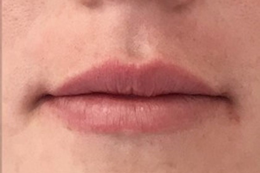 Lippenkorrektur resultate - 778923