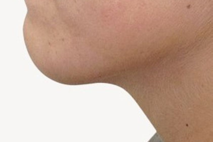 Ultraschall Fettabsaugung resultate - 778925