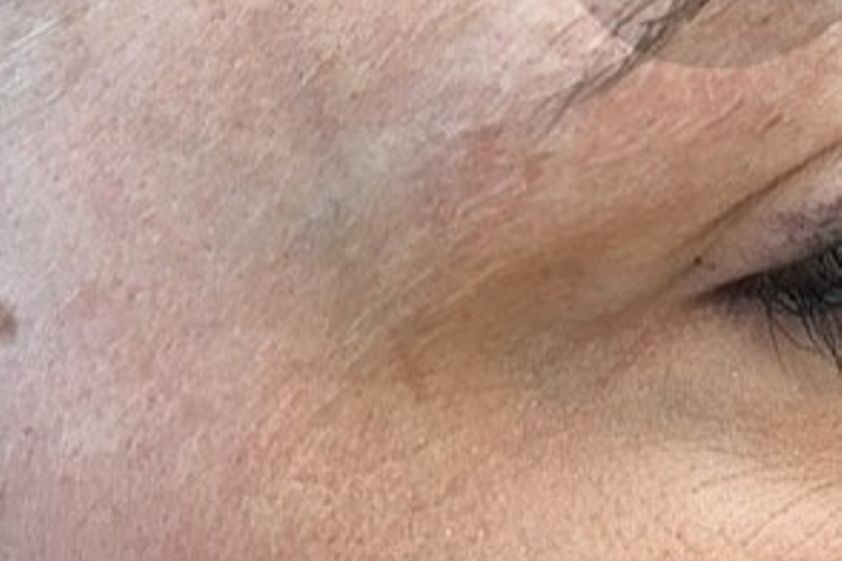 Pigmentflecken resultate - 778930