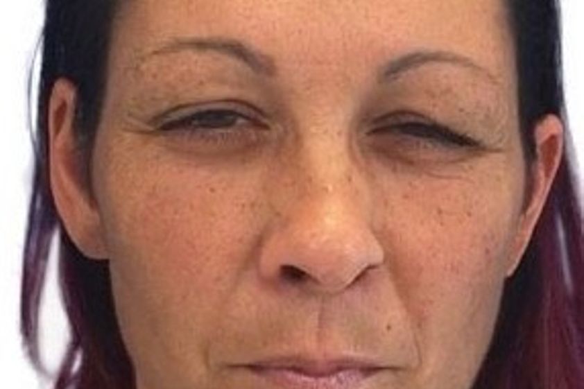 Botox resultate - 778931