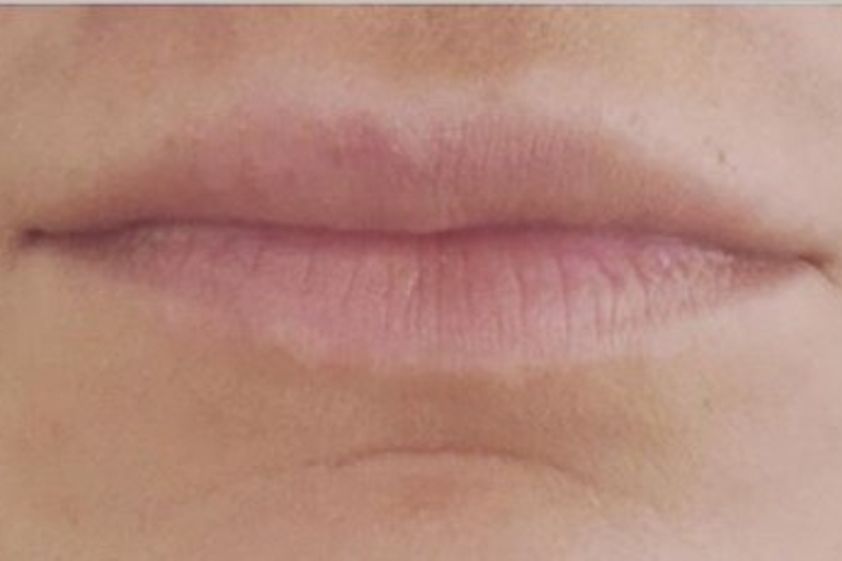 Lippenvergrößerung mit Hyaluronsäure resultate - 778952