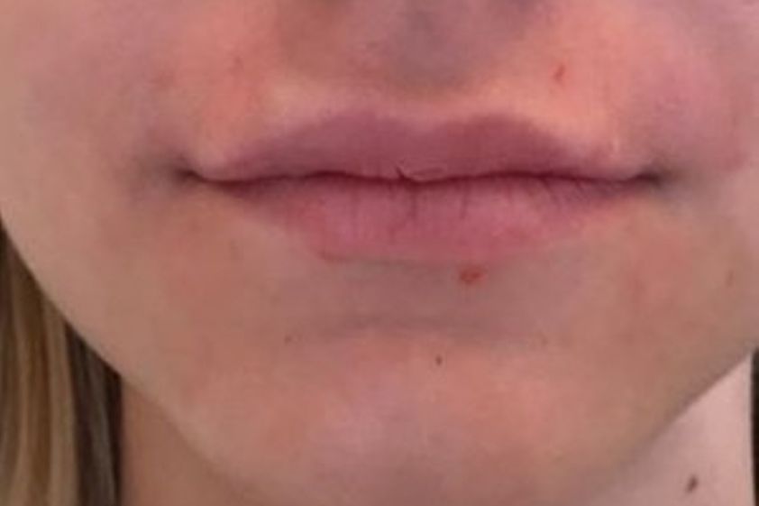 Lippenvergrößerung mit Hyaluronsäure resultate - 778965