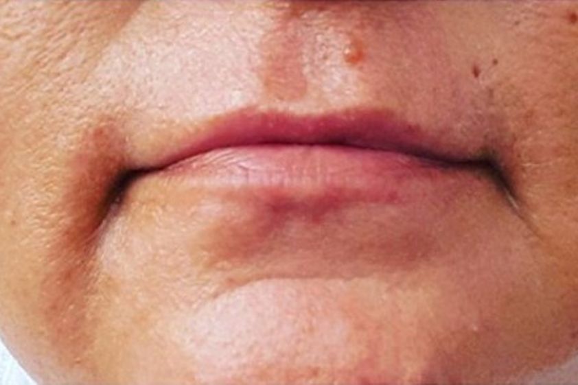 Lippenkorrektur resultate - 778969