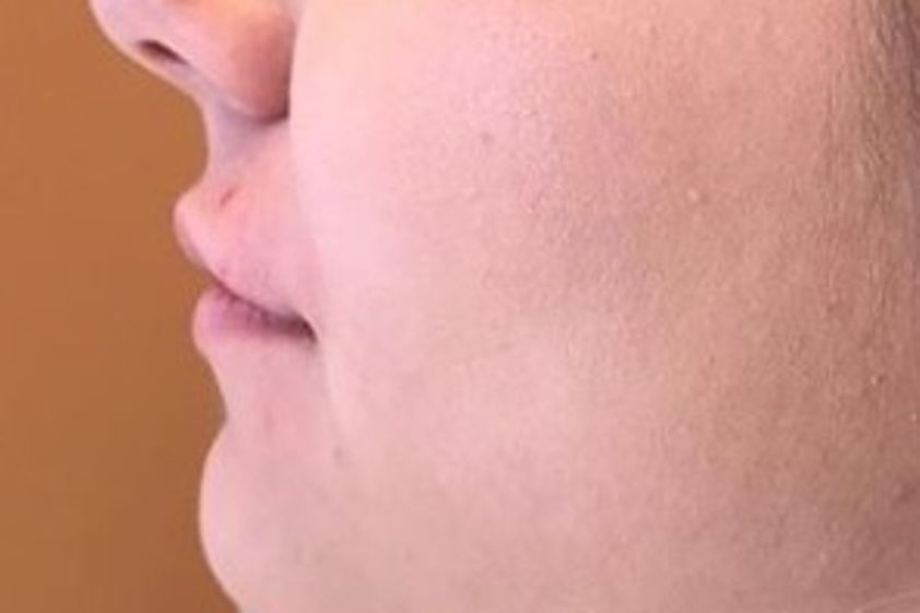 Lippenvergrößerung mit Hyaluronsäure resultate - 778977