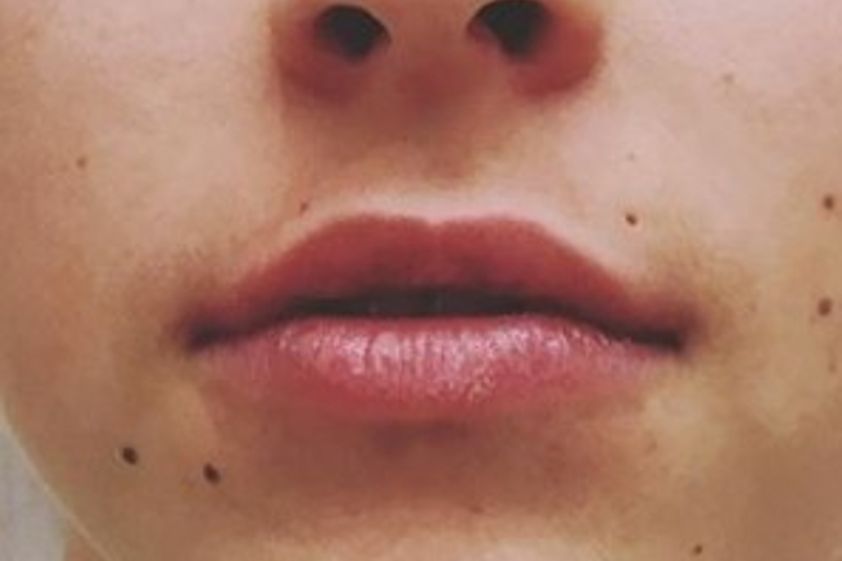 Lippenvergrößerung mit Hyaluronsäure resultate - 778984