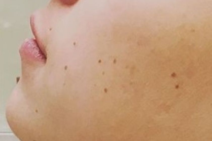 Lippenvergrößerung mit Hyaluronsäure resultate - 778988