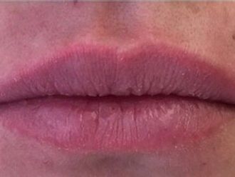 Lippenvergrößerung mit Hyaluronsäure - 778995