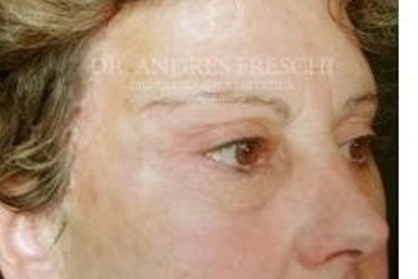Augenbrauenlifting resultate - 777243