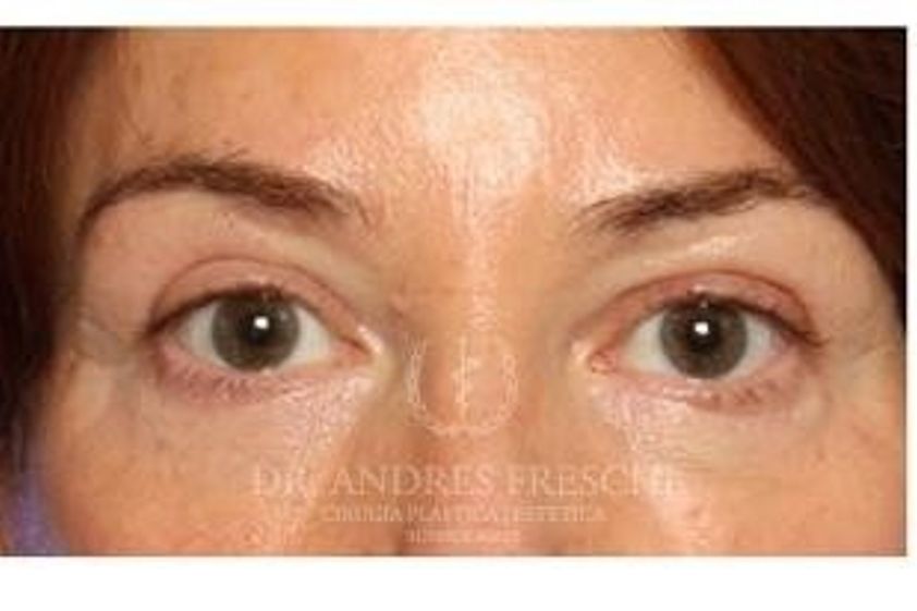 Augenbrauenlifting resultate - 777245