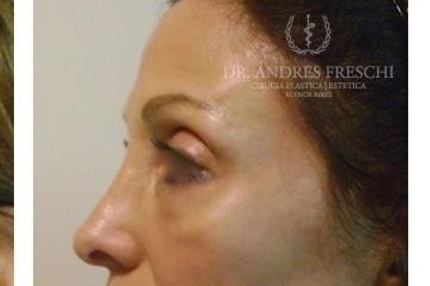 Augenbrauenlifting resultate - 777248