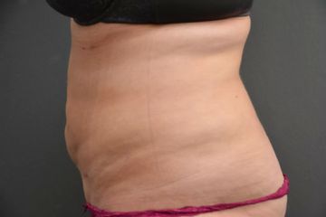 Fettabsaugung Bauch   Vorher