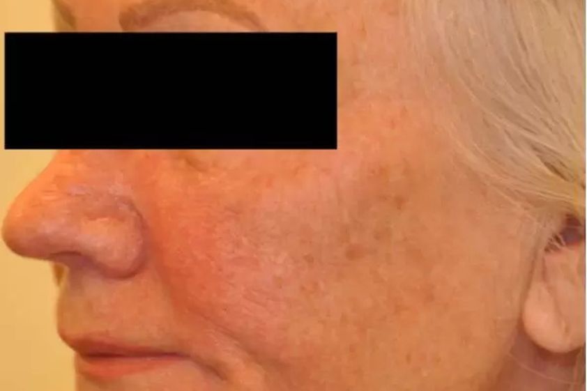 Faltenbehandlung resultate - 783721