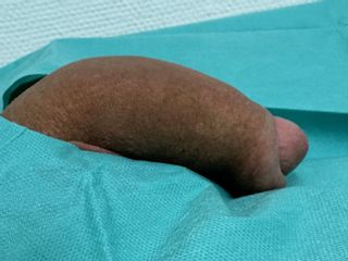 Penisverdickung mit Hyaluronsäure - Dr.med. Aref Elseweifi