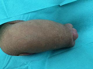 Penisverdickung mit Hyaluronsäure - Dr.med. Aref Elseweifi