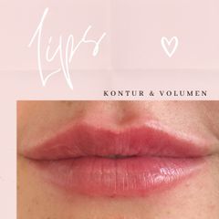 Lippen aufspritzen - Faltenlos - Larissa Greuel
