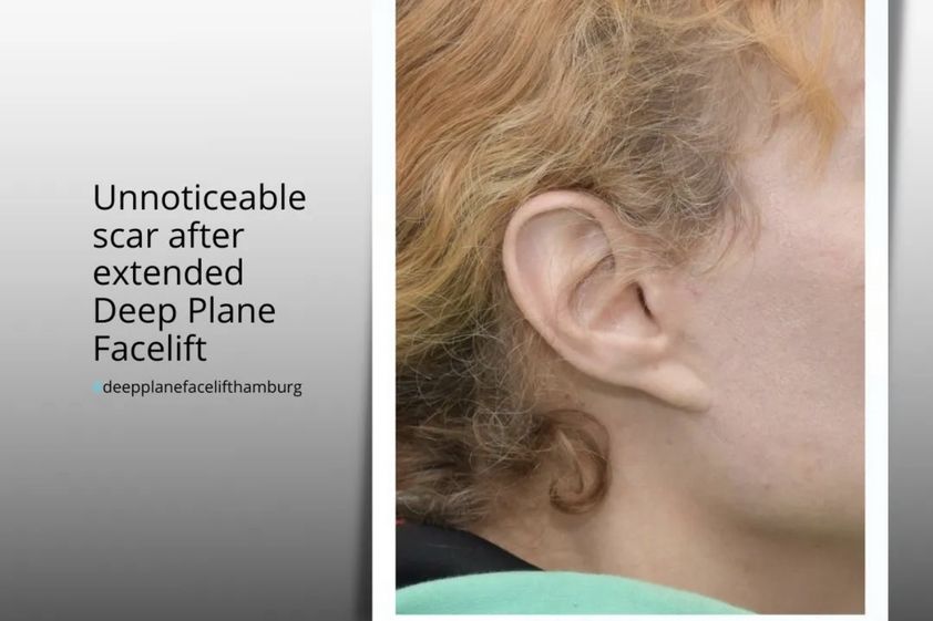 Facelift resultate - 854959