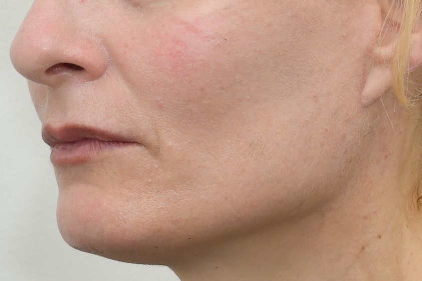 Facelift resultate - 854963