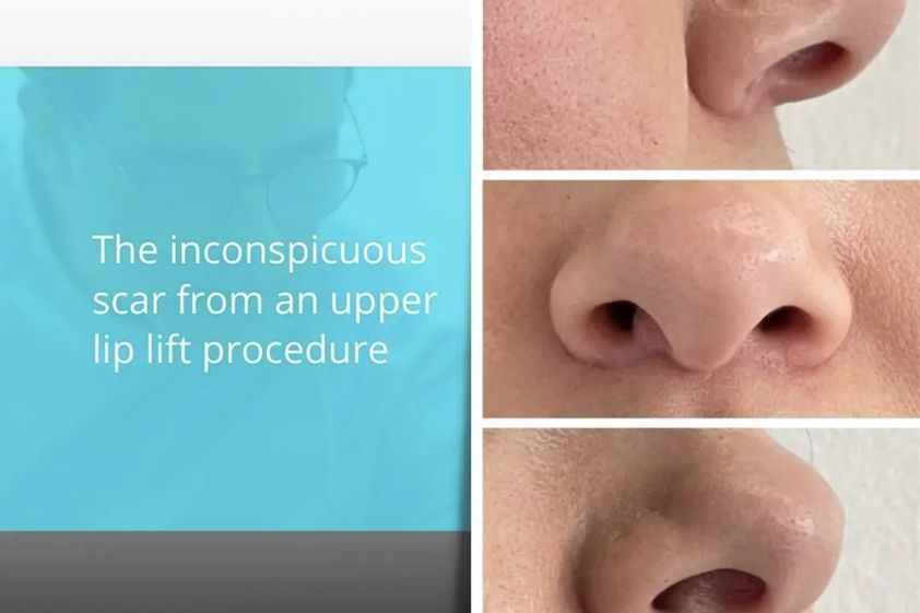 Lippenlifting resultate - 854973