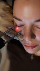 Fraktionierte Laser gegen Fältchen