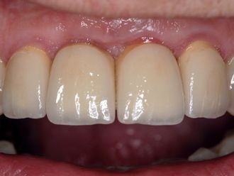 Zahnimplantat - 780965