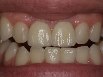 Zahnimplantat - 780966